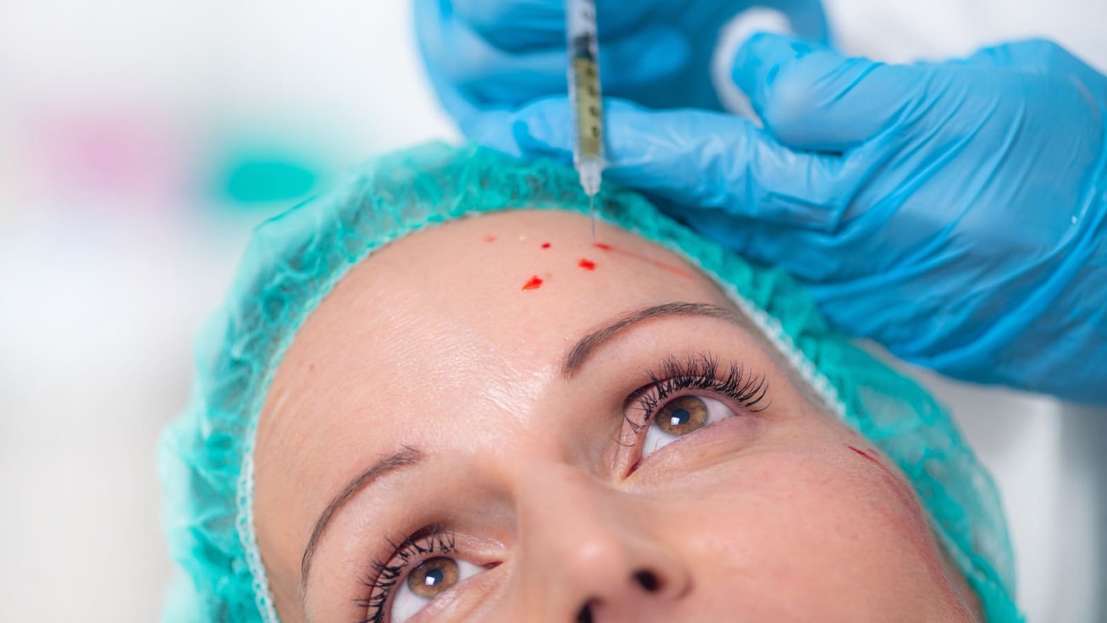 Microneedling for Face in Pune — Acne Scar Treatment